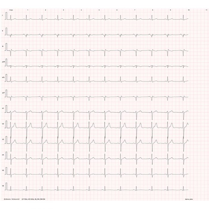 iCV200 Cardioview Resting ECG