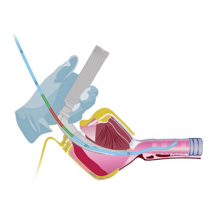 Bougie Injection Adroit Tactical Bougie | Patent Safety Markings | Free Delivery Over £ ...