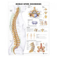 Laminated Anatomical Chart (Spine Disorder)