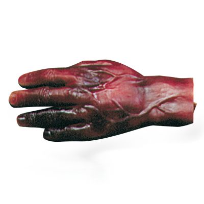 Non Bleeding Moulage (2nd & 3rd Degree Burns of Hand)